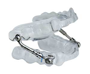 Foto de um dispositivo de avanço mandibular para tratar o ronco e apneia do sono