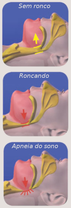 Diferença entre pessoa sem roncar, pessoa roncando e com apneia do sono