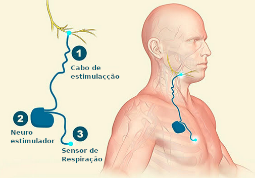 Funcionamento da tecnologia Inspire, para tratamento da apneia do sono