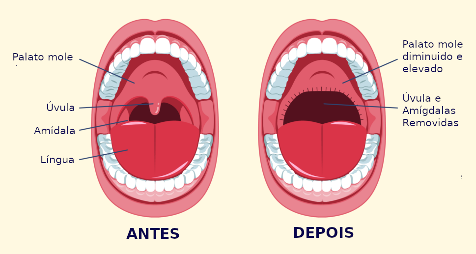 Foto mostrando o antes e depois da cirurgia de UPPP ou uvulopalatofaringoplastia